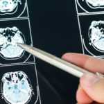 Sepa qué es la lesión cerebral traumática (TBI)