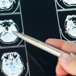 Know what is traumatic brain injury (TBI)