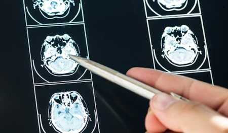 Dowiedz się, co to jest urazowe uszkodzenie mózgu (TBI)