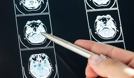 Sepa qué es la lesión cerebral traumática (TBI)