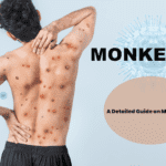 Monkeypox: Everything You Need To Know
