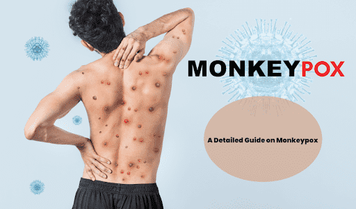 Monkeypox: Everything You Need To Know